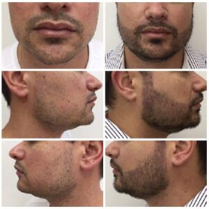 Transplante de Barba AC Clínica Cirurgia Plástica Brasilia DF