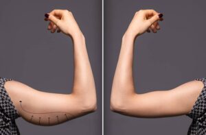 Braquioplastia: entenda a cirurgia plástica dos braços